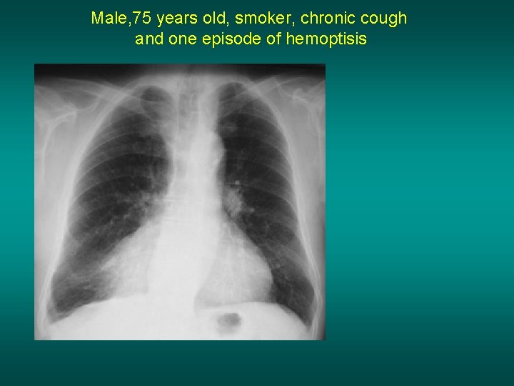 Male, 75 years old, smoker, chronic cough and one episode of hemoptisis 