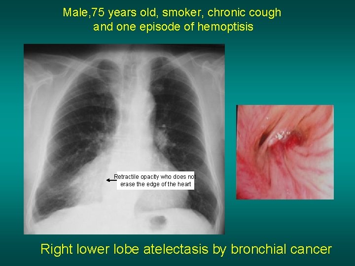 Male, 75 years old, smoker, chronic cough and one episode of hemoptisis Retractile opacity