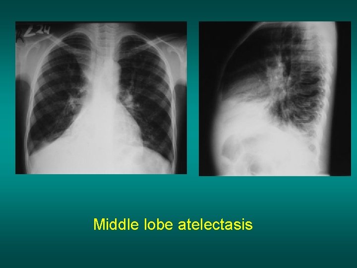 Middle lobe atelectasis 