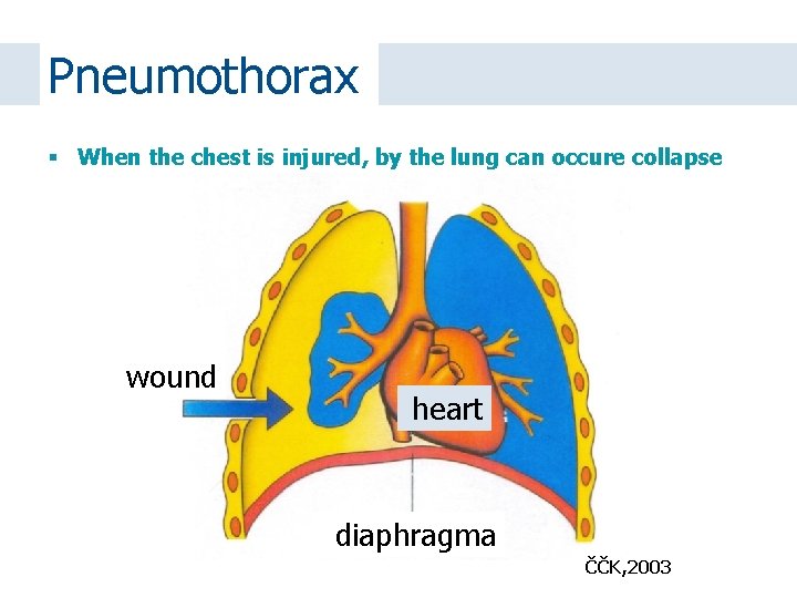 Pneumothorax When the chest is injured, by the lung can occure collapse wound heart