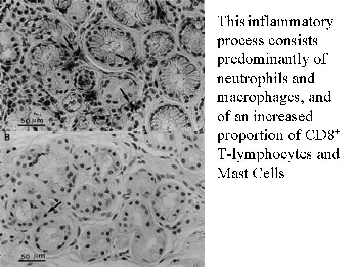 This inflammatory process consists predominantly of neutrophils and macrophages, and of an increased proportion