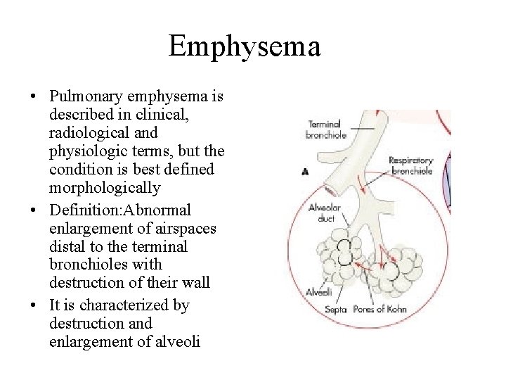 Emphysema • Pulmonary emphysema is described in clinical, radiological and physiologic terms, but the