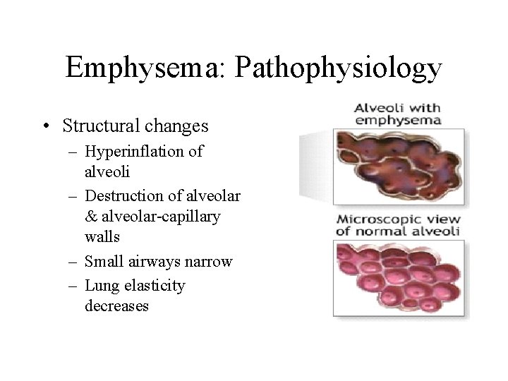 Emphysema: Pathophysiology • Structural changes – Hyperinflation of alveoli – Destruction of alveolar &