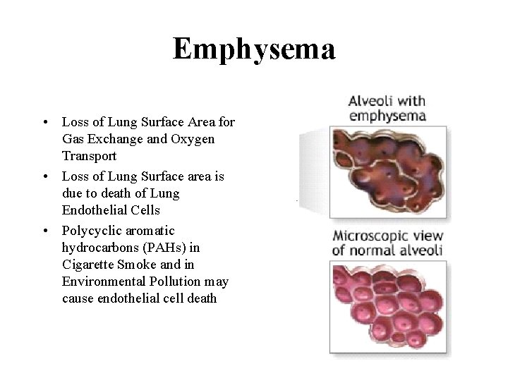 Emphysema • Loss of Lung Surface Area for Gas Exchange and Oxygen Transport •