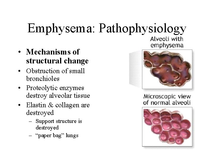 Emphysema: Pathophysiology • Mechanisms of structural change • Obstruction of small bronchioles • Proteolytic