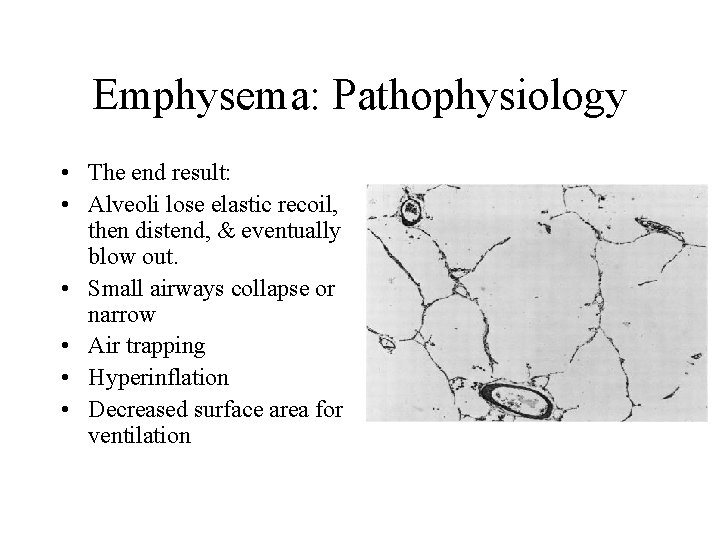 Emphysema: Pathophysiology • The end result: • Alveoli lose elastic recoil, then distend, &