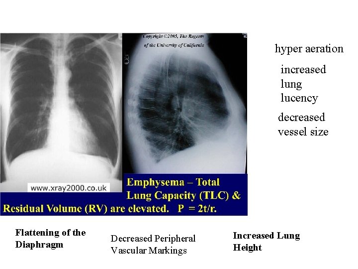 hyper aeration increased lung lucency decreased vessel size Flattening of the Diaphragm Decreased Peripheral