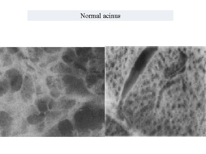 Normal acinus 
