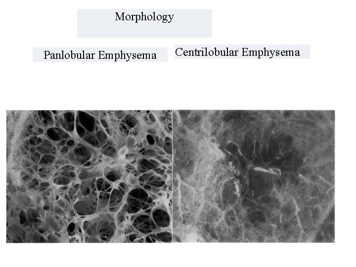 Morphology Panlobular Emphysema Centrilobular Emphysema 