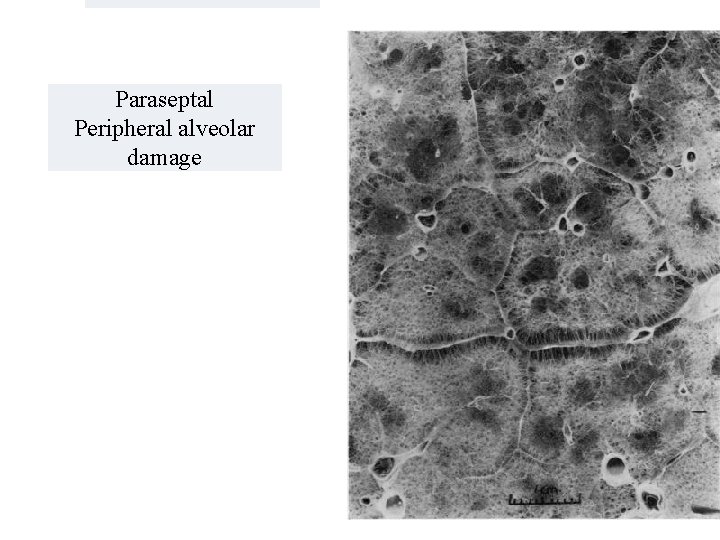 Paraseptal Peripheral alveolar damage 