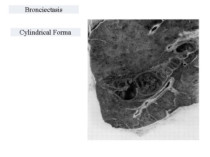 Bronciectasis Cylindrical Forma 