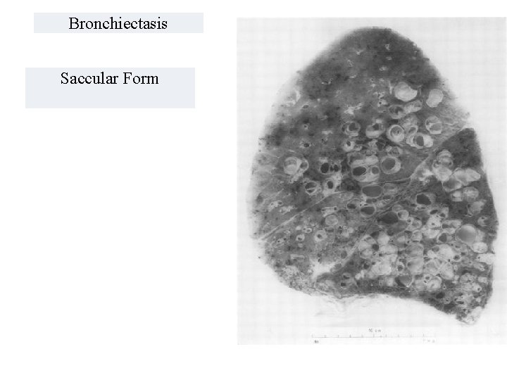 Bronchiectasis Saccular Form 