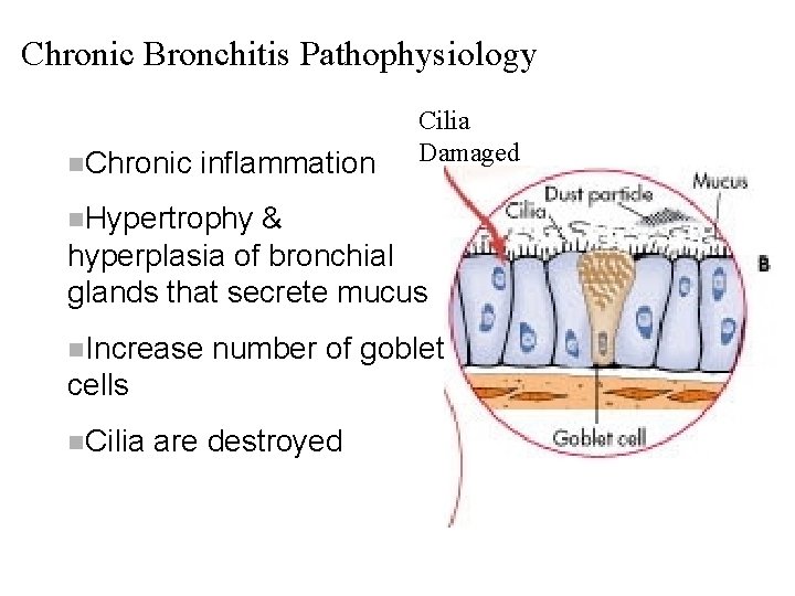 Chronic Bronchitis Pathophysiology n. Chronic inflammation Cilia Damaged n. Hypertrophy & hyperplasia of bronchial