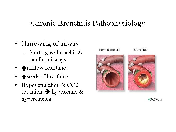 Chronic Bronchitis Pathophysiology • Narrowing of airway – Starting w/ bronchi smaller airways •
