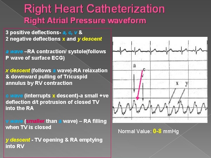Right Heart Catheterization Right Atrial Pressure waveform 3 positive deflections- a, c, v &