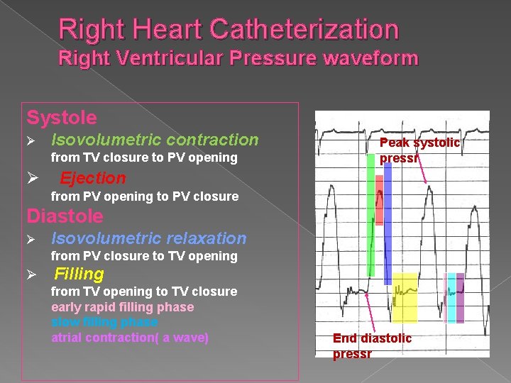 Right Heart Catheterization Right Ventricular Pressure waveform Systole Ø Isovolumetric contraction from TV closure
