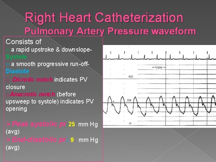 Right Heart Catheterization Pulmonary Artery Pressure waveform Consists of o a rapid upstroke &