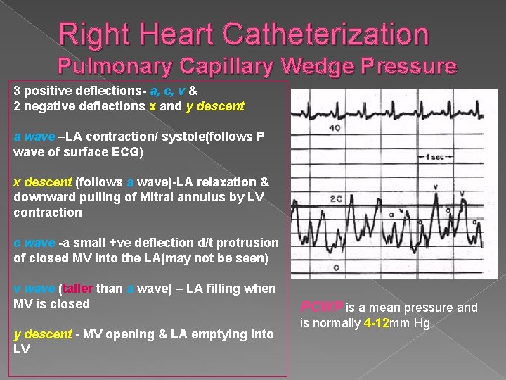 Right Heart Catheterization Pulmonary Capillary Wedge Pressure 3 positive deflections- a, c, v &