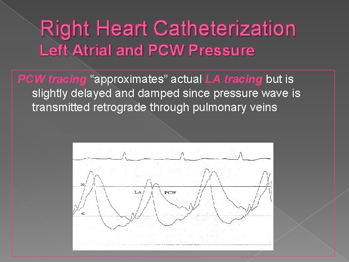 Right Heart Catheterization Left Atrial and PCW Pressure PCW tracing “approximates” actual LA tracing