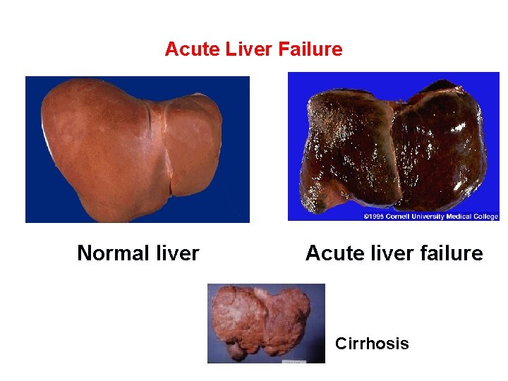 Acute Liver Failure Normal liver Acute liver failure Cirrhosis 