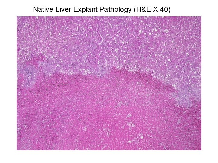 Native Liver Explant Pathology (H&E X 40) 