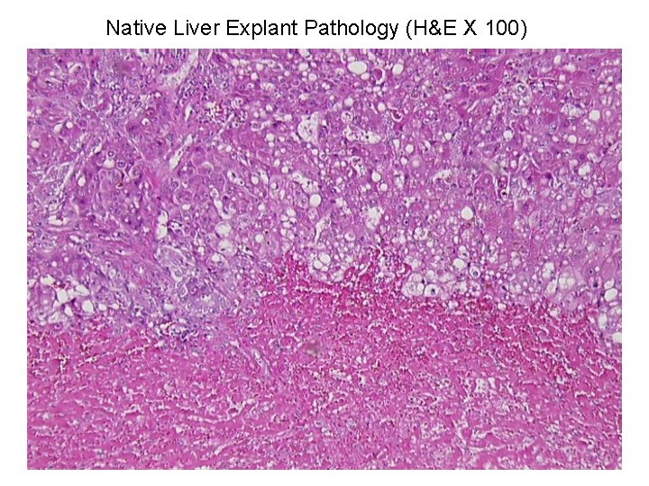 Native Liver Explant Pathology (H&E X 100) 