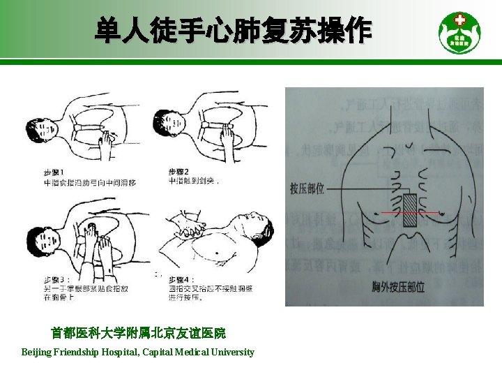 单人徒手心肺复苏操作 首都医科大学附属北京友谊医院 Beijing Friendship Hospital, Capital Medical University 