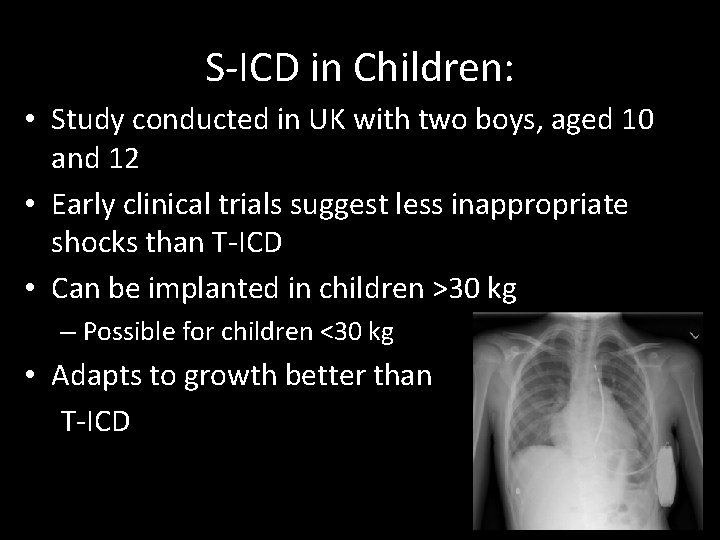 S-ICD in Children: • Study conducted in UK with two boys, aged 10 and