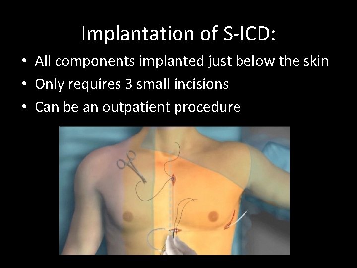 Implantation of S-ICD: • All components implanted just below the skin • Only requires
