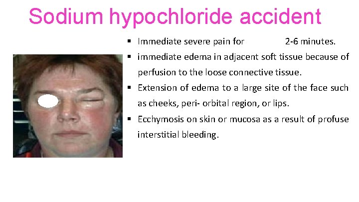 Sodium hypochloride accident § Immediate severe pain for 2 -6 minutes. § immediate edema