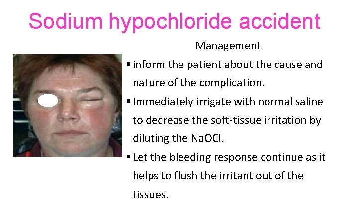 Sodium hypochloride accident Management § inform the patient about the cause and nature of