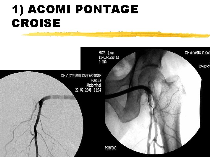 1) ACOMI PONTAGE CROISE 