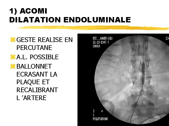 1) ACOMI DILATATION ENDOLUMINALE z GESTE REALISE EN PERCUTANE z A. L. POSSIBLE z