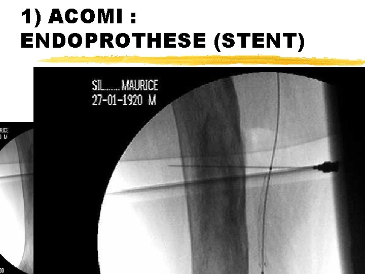 1) ACOMI : ENDOPROTHESE (STENT) 