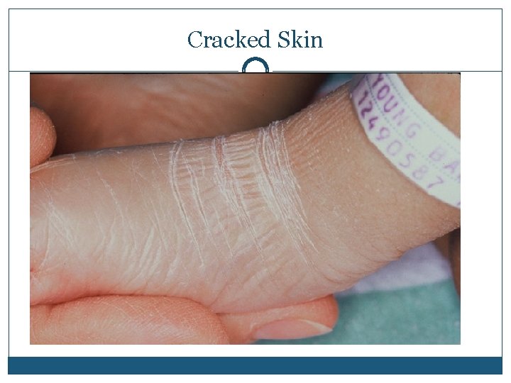 Cracked Skin 