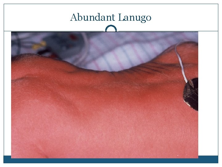 Abundant Lanugo 