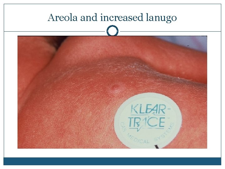 Areola and increased lanugo 