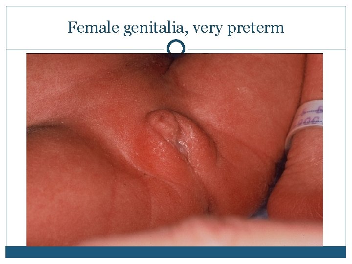 Female genitalia, very preterm 