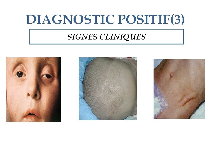 DIAGNOSTIC POSITIF(3) SIGNES CLINIQUES 