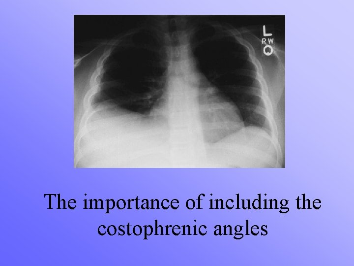 The importance of including the costophrenic angles 