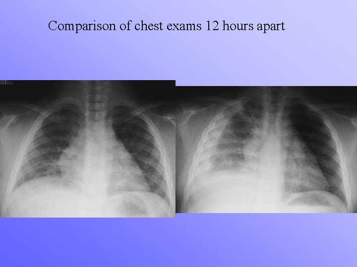 Comparison of chest exams 12 hours apart 