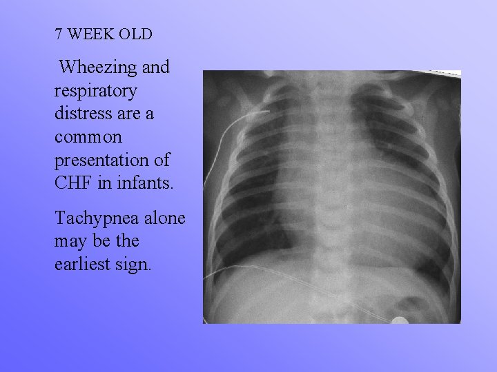 7 WEEK OLD Wheezing and respiratory distress are a common presentation of CHF in