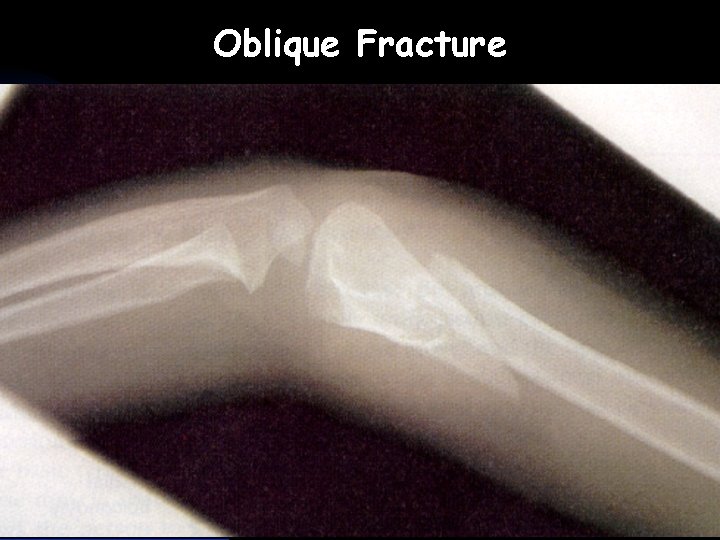 Oblique Fracture  Oblique Fracture