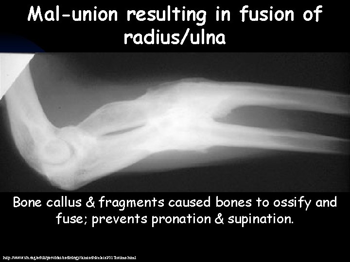 Mal-union resulting in fusion of radius/ulna Bone callus & fragments caused bones to ossify Mal-union resulting in fusion of radius/ulna Bone callus & fragments caused bones to ossify
