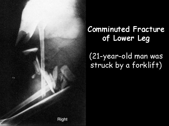 Comminuted Fracture of Lower Leg (21 -year-old man was struck by a forklift)  Comminuted Fracture of Lower Leg (21 -year-old man was struck by a forklift)