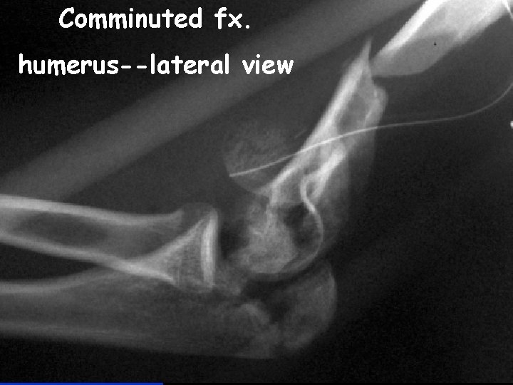 Comminuted fx. humerus--lateral view 