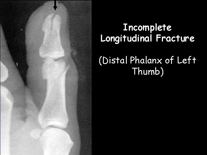 Incomplete Longitudinal Fracture (Distal Phalanx of Left Thumb) 