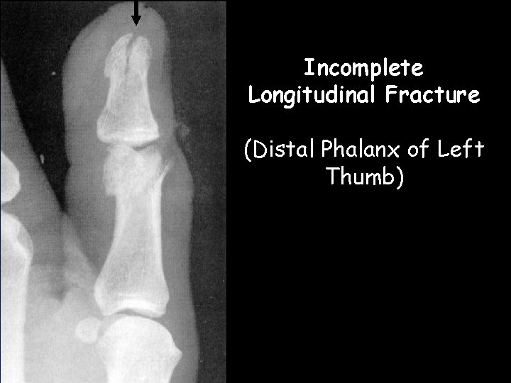 Incomplete Longitudinal Fracture (Distal Phalanx of Left Thumb)  Incomplete Longitudinal Fracture (Distal Phalanx of Left Thumb)