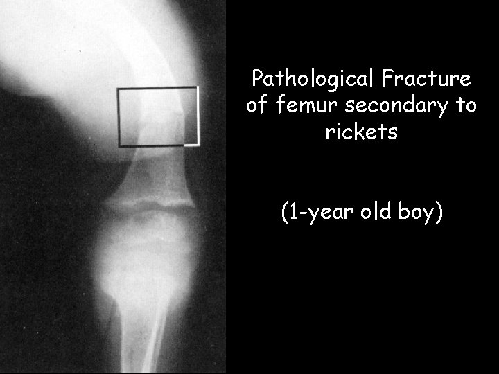 Pathological Fracture of femur secondary to rickets (1 -year old boy)  Pathological Fracture of femur secondary to rickets (1 -year old boy)