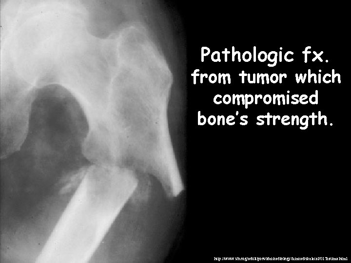 Pathologic fx. from tumor which compromised bone’s strength. http: //www. vh. org/adult/provider/radiology/icmrad/skeletal/01 Trauma. html